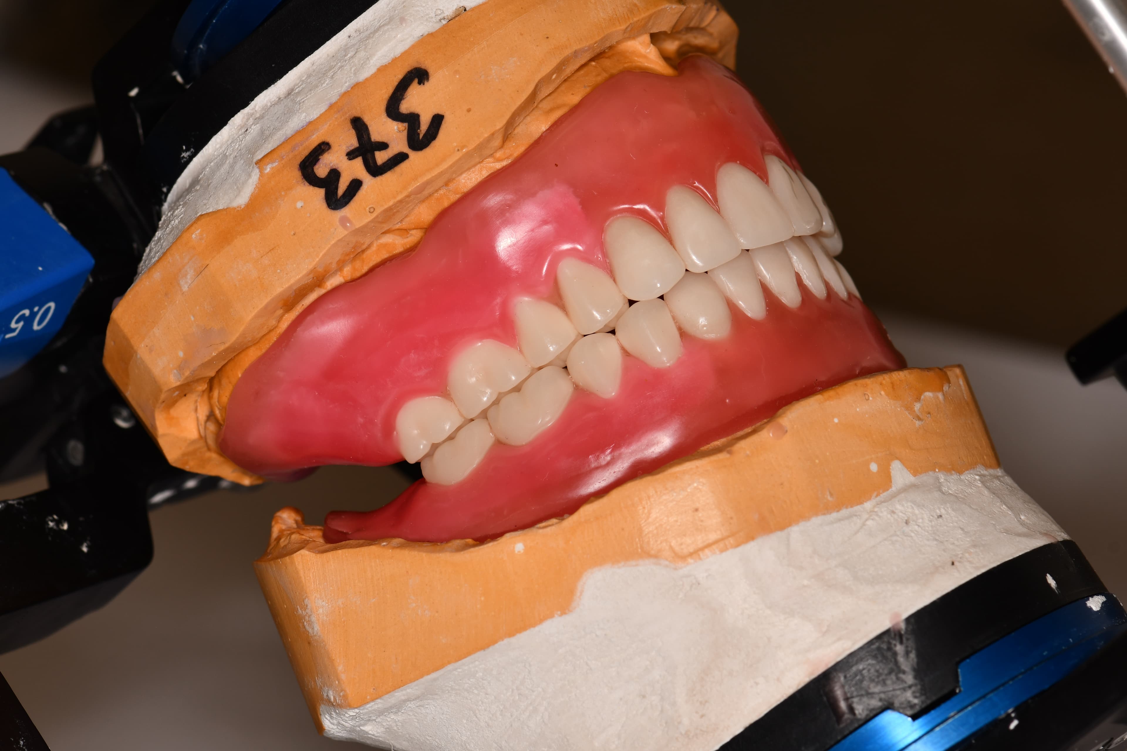 Comprehensive Full Mouth Rehabilitation with Complete Dentures