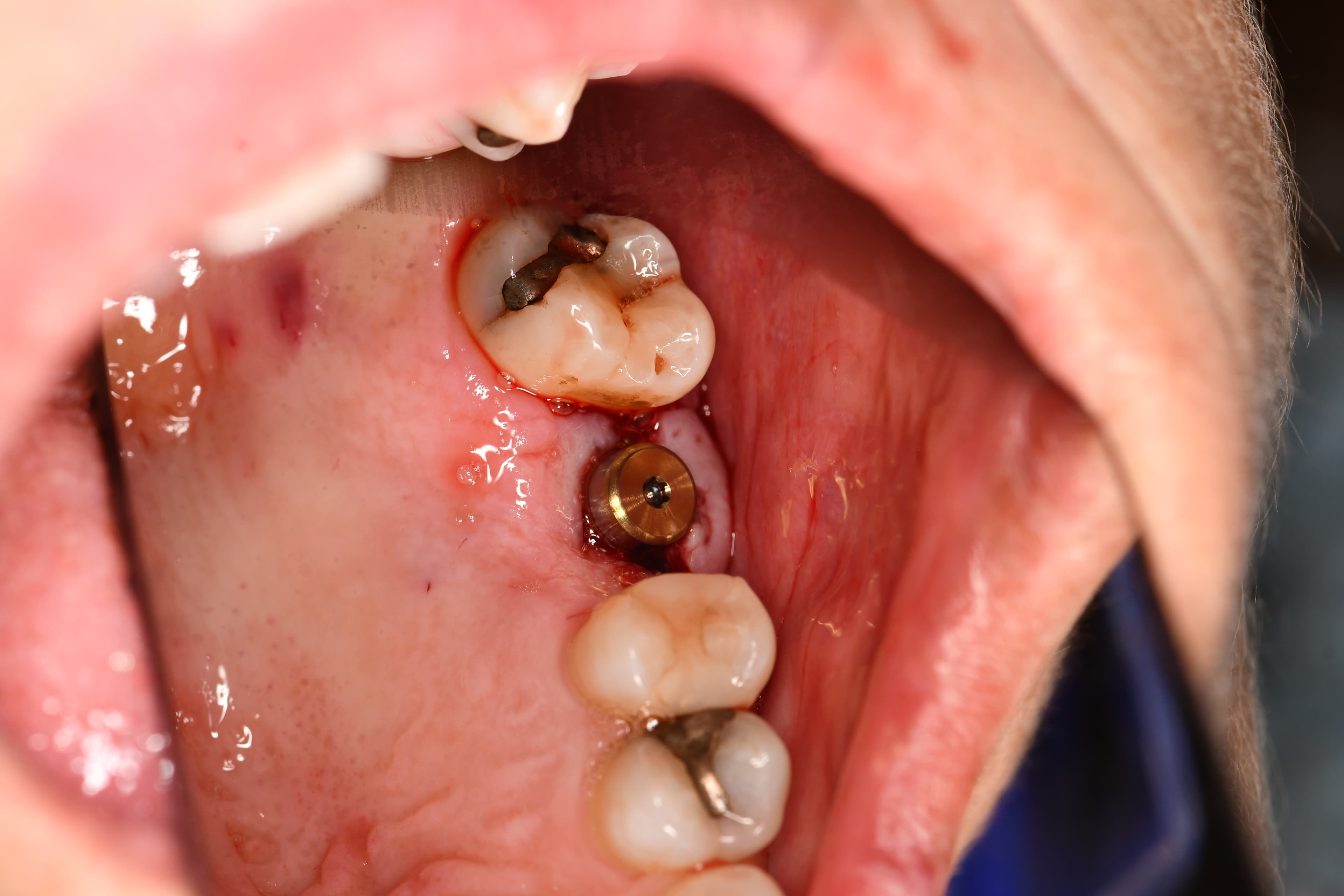 Comprehensive Dental Implant Placement for Restorative Rehabilitation