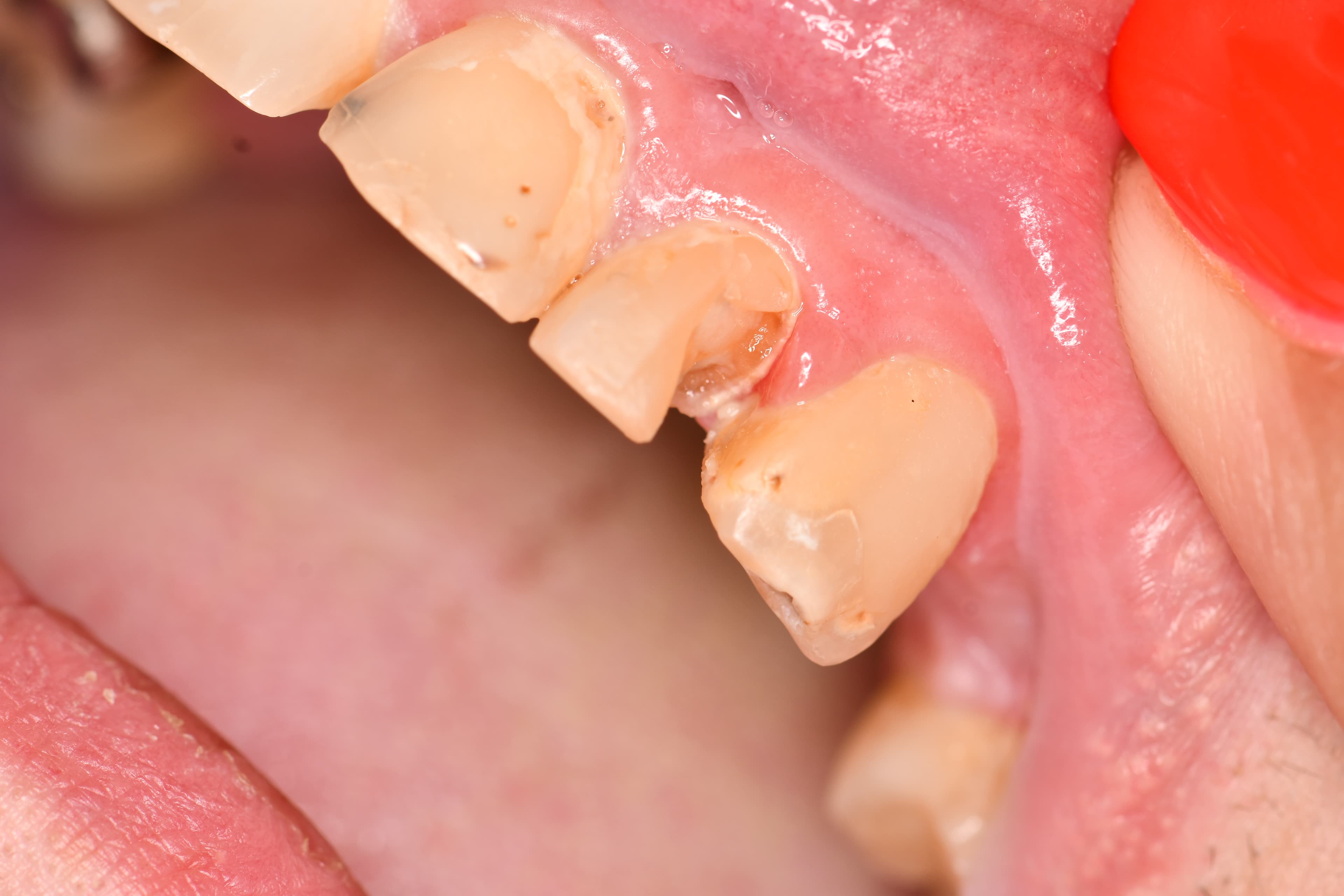 Emergency Composite Restorations