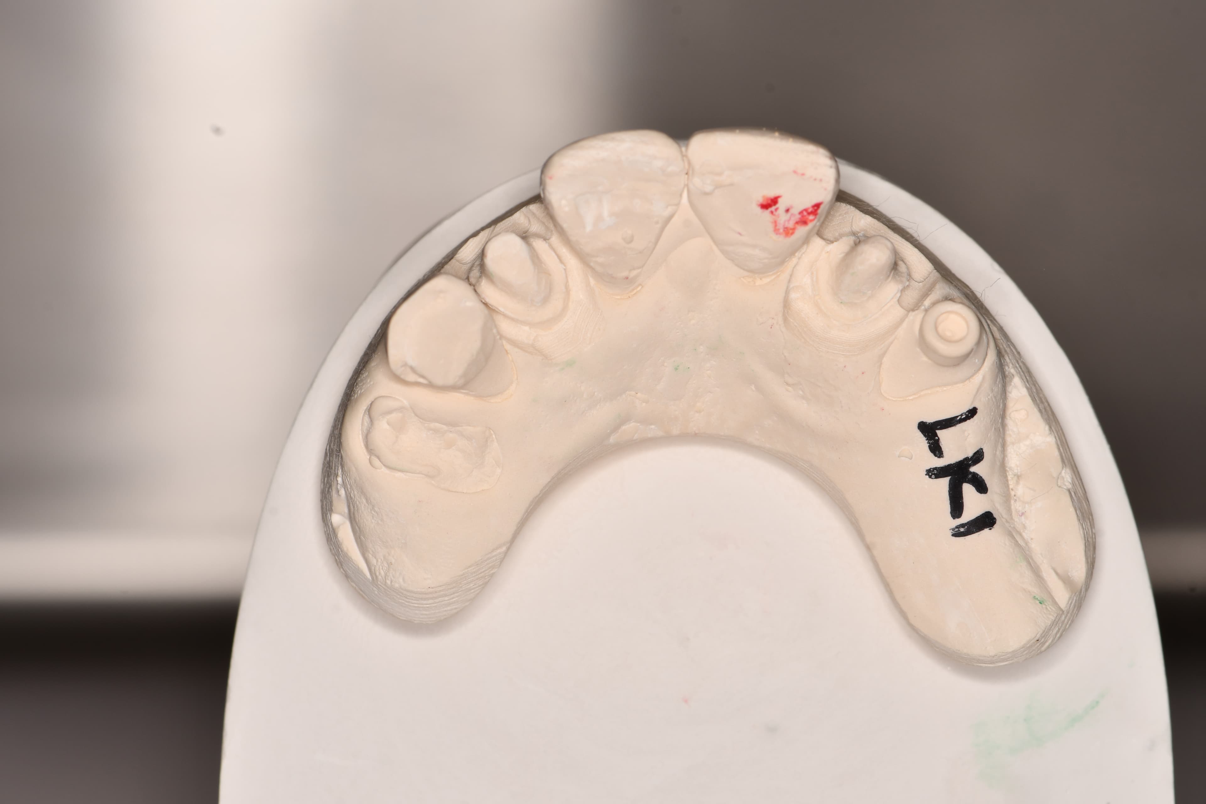 Comprehensive Dental Rehabilitation with Anterior Crown Restorations and Periodontal Maintenance