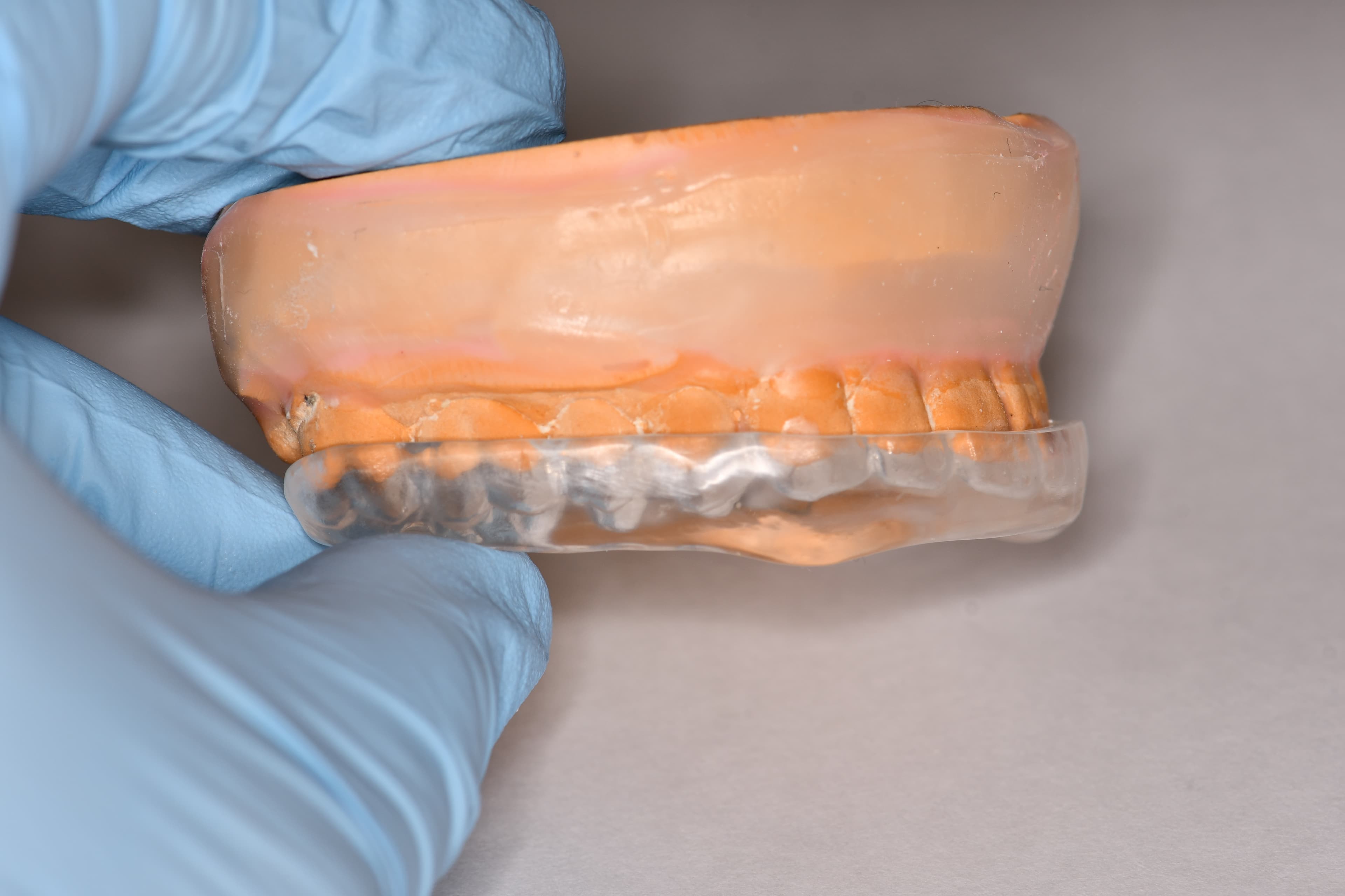 Night Guard Fabrication and Occlusal Filling