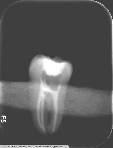 Root Canal Treatment on Extracted Tooth #18 Using a Comprehensive Endodontic Approach