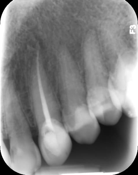 Comprehensive Management of Irreversible Pulpitis and Advanced Endodontic Therapy